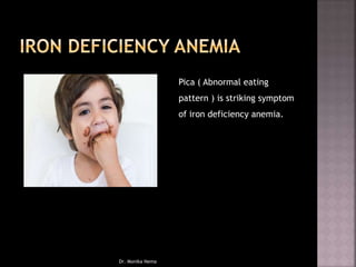 Pica ( Abnormal eating
pattern ) is striking symptom
of iron deficiency anemia.
Dr. Monika Nema
 