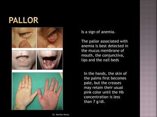 In the hands, the skin of
the palms first becomes
pale, but the creases
may retain their usual
pink color until the Hb
concentration is less
than 7 g/dl.
Is a sign of anemia.
The pallor associated with
anemia is best detected in
the mucus membrane of
mouth, the conjunctiva,
lips and the nail beds
Dr. Monika Nema
 