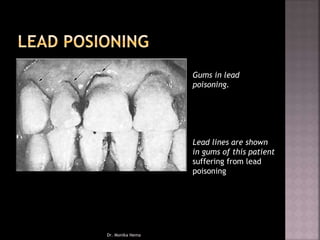 Gums in lead
poisoning.
Lead lines are shown
in gums of this patient
suffering from lead
poisoning
Dr. Monika Nema
 