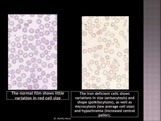 The normal film shows little
variation in red cell size
The iron deficient cells shows
variations in size (anisocytosis) and
shape (poikilocytosis), as well as
microcytosis (low average cell size)
and hypochromia (increased central
pallor).
Dr. Monika Nema
 