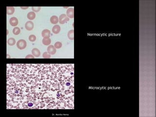 Normocytic picture
Microcytic picture
Dr. Monika Nema
 