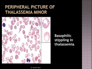 Basophilic
stippling in
thalassemia.
Dr. Monika Nema
 