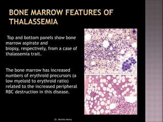 Top and bottom panels show bone
marrow aspirate and
biopsy, respectively, from a case of
thalassemia trait.
The bone marrow has increased
numbers of erythroid precursors (a
low myeloid to erythroid ratio)
related to the increased peripheral
RBC destruction in this disease.
Dr. Monika Nema
 