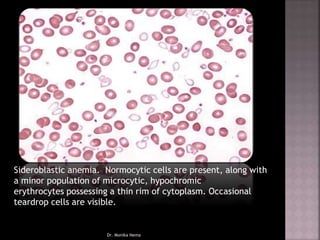 Sideroblastic anemia. Normocytic cells are present, along with
a minor population of microcytic, hypochromic
erythrocytes possessing a thin rim of cytoplasm. Occasional
teardrop cells are visible.
Dr. Monika Nema
 