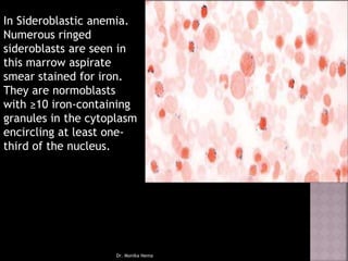 In Sideroblastic anemia.
Numerous ringed
sideroblasts are seen in
this marrow aspirate
smear stained for iron.
They are normoblasts
with ≥10 iron-containing
granules in the cytoplasm
encircling at least one-
third of the nucleus.
Dr. Monika Nema
 