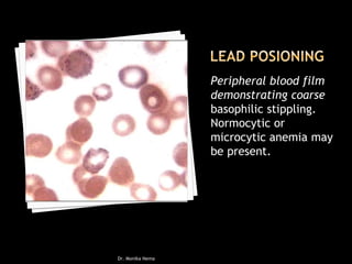Peripheral blood film
demonstrating coarse
basophilic stippling.
Normocytic or
microcytic anemia may
be present.
Dr. Monika Nema
 