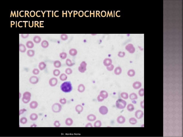 Microcytic Anemia microcytic-anemia