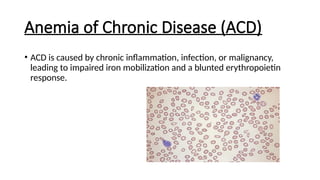 Anemia of Chronic Disease (ACD)
• ACD is caused by chronic inflammation, infection, or malignancy,
leading to impaired iron mobilization and a blunted erythropoietin
response.
 