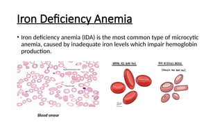 Iron Deficiency Anemia
• Iron deficiency anemia (IDA) is the most common type of microcytic
anemia, caused by inadequate iron levels which impair hemoglobin
production.
Blood smear
 