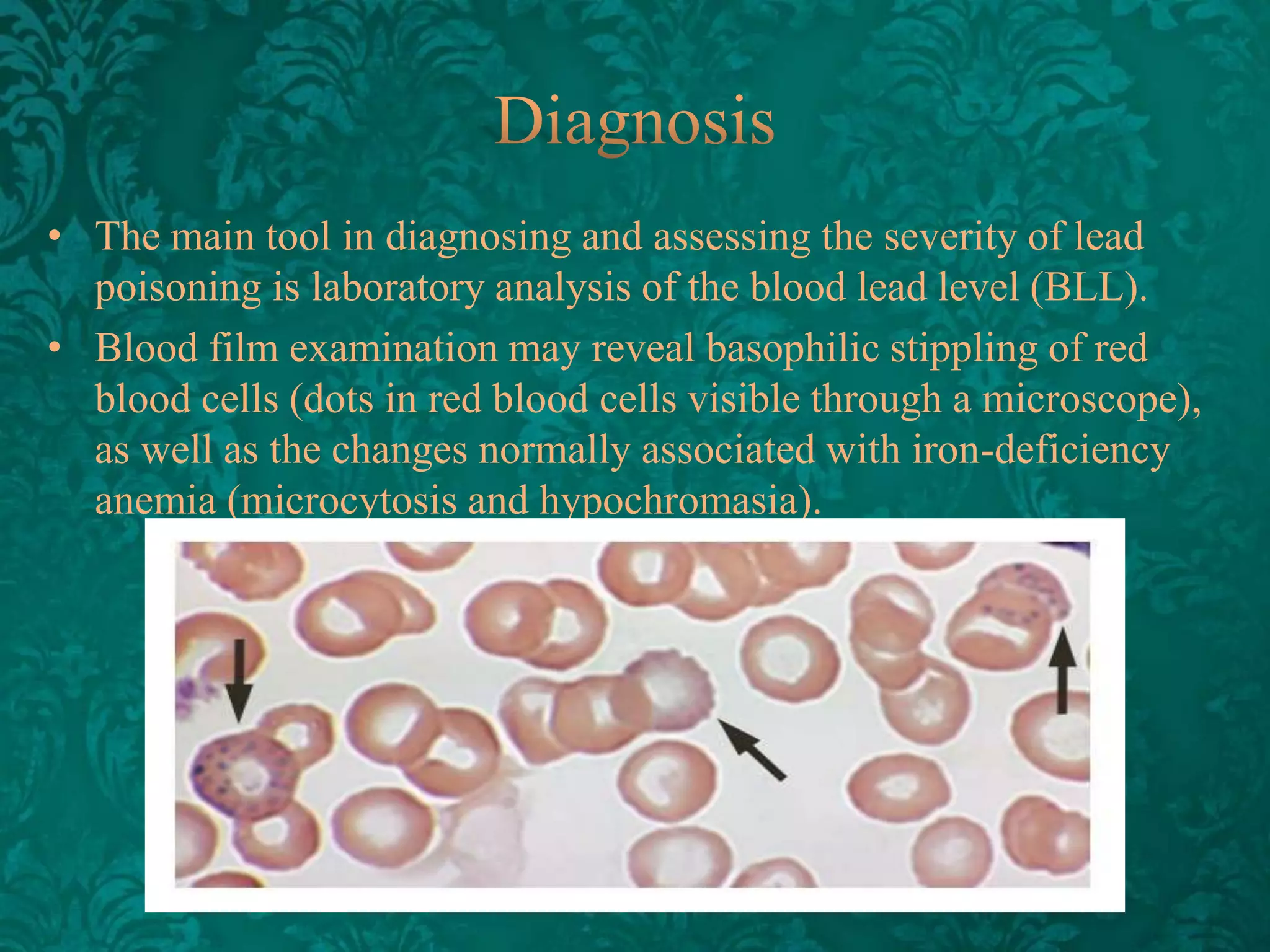 • The main tool in diagnosing and assessing the severity of lead
poisoning is laboratory analysis of the blood lead level (BLL).
• Blood film examination may reveal basophilic stippling of red
blood cells (dots in red blood cells visible through a microscope),
as well as the changes normally associated with iron-deficiency
anemia (microcytosis and hypochromasia).

 