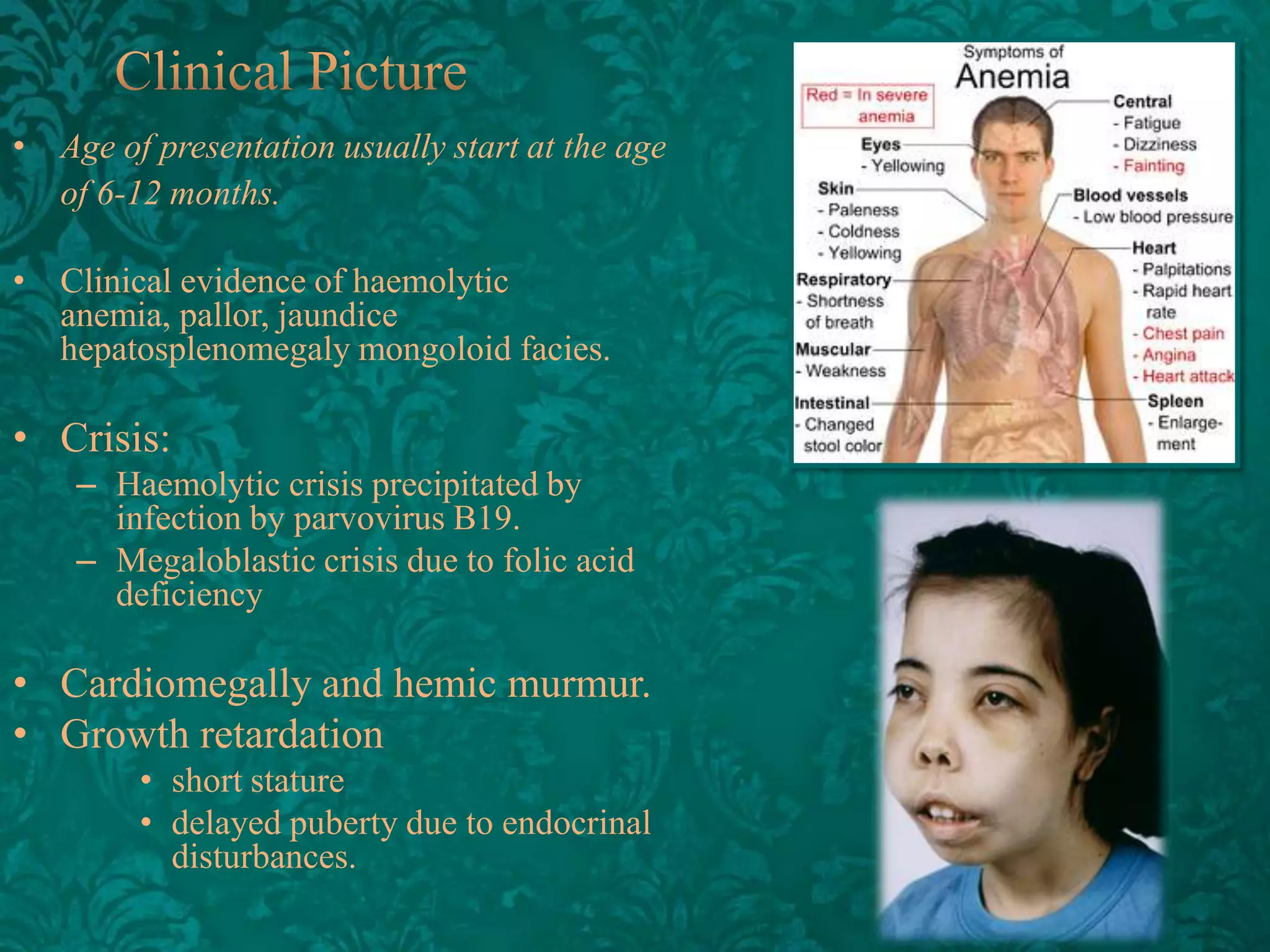 • Age of presentation usually start at the age
of 6-12 months.
• Clinical evidence of haemolytic
anemia, pallor, jaundice
hepatosplenomegaly mongoloid facies.

• Crisis:
– Haemolytic crisis precipitated by
infection by parvovirus B19.
– Megaloblastic crisis due to folic acid
deficiency

• Cardiomegally and hemic murmur.
• Growth retardation
• short stature
• delayed puberty due to endocrinal
disturbances.

 