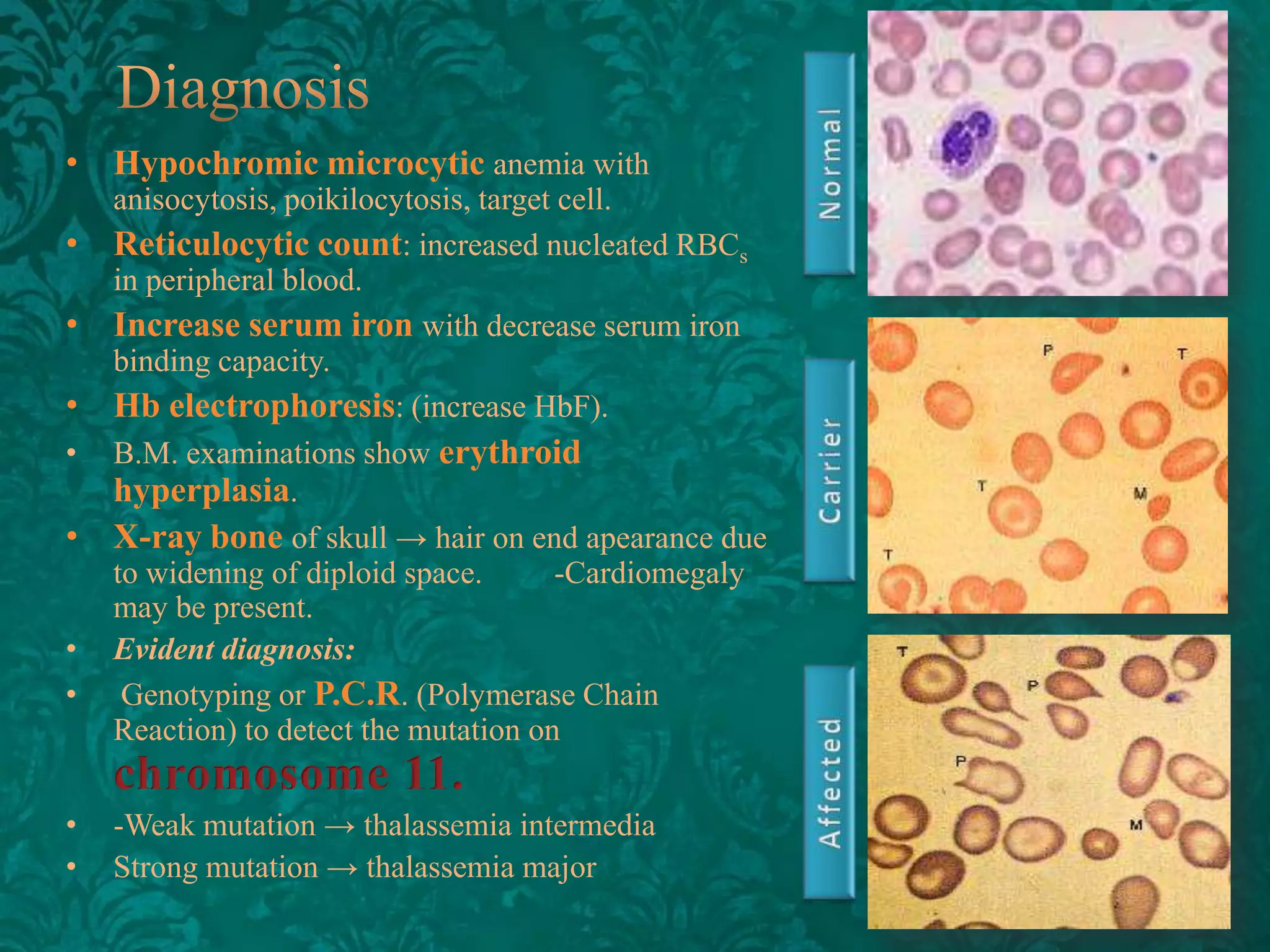 • Hypochromic microcytic anemia with
•

•
•
•

•
•
•

•
•

anisocytosis, poikilocytosis, target cell.
Reticulocytic count: increased nucleated RBCs
in peripheral blood.
Increase serum iron with decrease serum iron
binding capacity.
Hb electrophoresis: (increase HbF).
B.M. examinations show erythroid
hyperplasia.
X-ray bone of skull → hair on end apearance due
to widening of diploid space.
-Cardiomegaly
may be present.
Evident diagnosis:
Genotyping or P.C.R. (Polymerase Chain
Reaction) to detect the mutation on
-Weak mutation → thalassemia intermedia
Strong mutation → thalassemia major

 