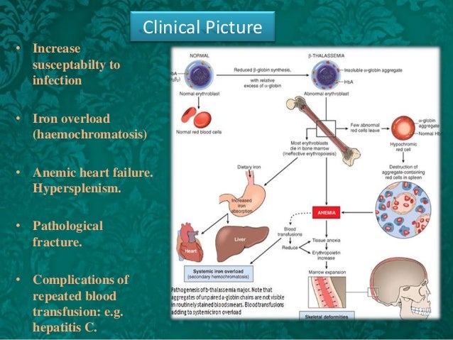 Microcytic hypochromic anemia