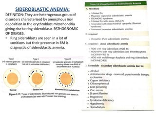 SIDEROBLASTIC ANEMIA:
DEFINITON: They are heterogenous group of
disorders characterised by amorphous iron
deposition in the erythroblast mitochondria
giving rise to ring sideroblasts-PATHOGNOMIC
OF DIEASES.
• Ring sideroblasts are seen in a lot of
conitions but their presence in BM is
diagnostic of sideroblastic anemia.
 