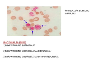 PERINUCLEAR SIDEROTIC
GRANULES.
(B)CLONAL SA (MDS)
1)MDS WITH RING SIDEROBLAST
2)MDS WITH RING SIDEROBLAST AND DYSPLASIA
3)MDS WITH RING SIDEROBLAST AND THROMBOCYTOSIS.
 