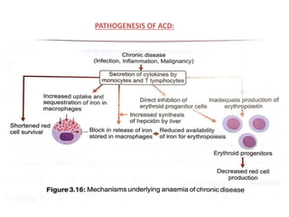 PATHOGENESIS OF ACD:
 