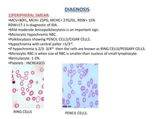 DIAGNOSIS:
1)PERIPHERAL SMEAR:
•MCV<80FL, MCH< 25PG, MCHC< 27G/DL, RDW> 15%
RDW>17.1 is diagnostic of IDA.
•Mild-moderate Anisopoikilocytosis is an important sign.
•Microcytic hypochromic RBC.
•Poikilocytosis showing PENCIL CELLS/CIGAR CELLS.
•Hypochromia with central pallor >1/3rd.
•If hypochromia is 2/3- 3/4th then the cells are known as RING CELLS/PESSARY CELLS.
•Microcytic RBC is when size of RBC is smaller than nucleus of small lymphocyte.
•Reticulocyte: 1-2%
•Platelets : INCREASED.
RING CELLS PENCIL CELLS.
 