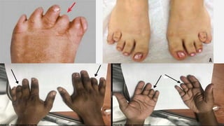 Microdactaly Microdactyly, macrodactyly and hemangioma.ppt
