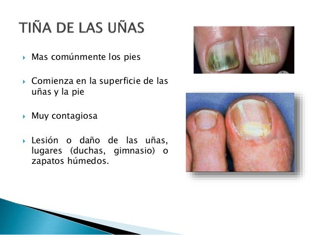 Cuanto ser curado el hongo sobre las uñas de los pies