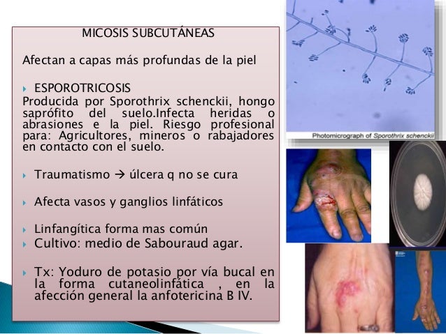 El tratamiento por la agua oxigenada por neumyvakinu el hongo de las uñas en los pies