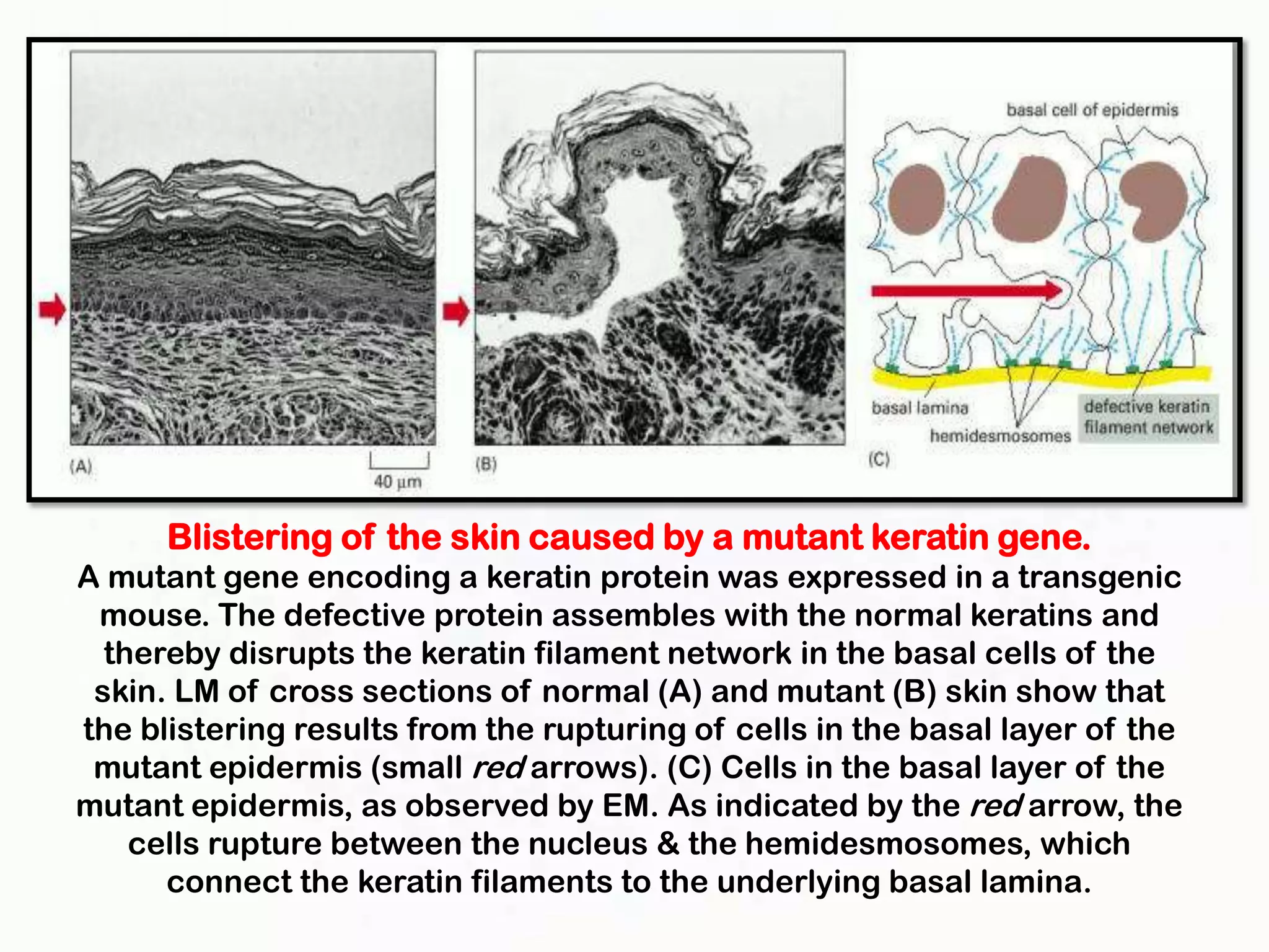 Blistering of the skin caused by a mutant keratin gene.
A mutant gene encoding a keratin protein was expressed in a transgenic
 mouse. The defective protein assembles with the normal keratins and
  thereby disrupts the keratin filament network in the basal cells of the
 skin. LM of cross sections of normal (A) and mutant (B) skin show that
the blistering results from the rupturing of cells in the basal layer of the
 mutant epidermis (small red arrows). (C) Cells in the basal layer of the
mutant epidermis, as observed by EM. As indicated by the red arrow, the
    cells rupture between the nucleus & the hemidesmosomes, which
      connect the keratin filaments to the underlying basal lamina.
 