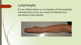 Lymphangitis
It is an inflammation or an infection of the lymphatic
channels that occurs as a result of infection at a
site distal to the channel.