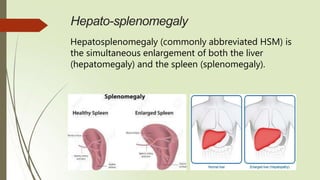 Hepato-splenomegaly
Hepatosplenomegaly (commonly abbreviated HSM) is
the simultaneous enlargement of both the liver
(hepatomegaly) and the spleen (splenomegaly).