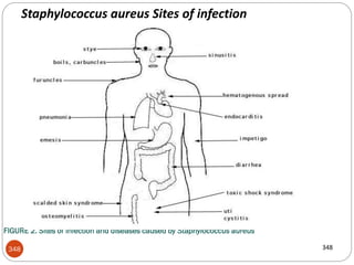 348
FIGURE 2. Sites of infection and diseases caused by Staphylococcus aureus
348
Staphylococcus aureus Sites of infection
 