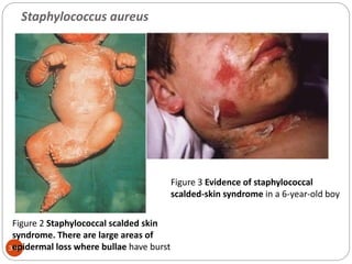 349
Figure 2 Staphylococcal scalded skin
syndrome. There are large areas of
epidermal loss where bullae have burst
Figure 3 Evidence of staphylococcal
scalded-skin syndrome in a 6-year-old boy
Staphylococcus aureus
 