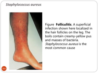 350
.
Figure Folliculitis. A superficial
infection shown here localized in
the hair follicles on the leg. The
boils contain creamy-yellow pus
and masses of bacteria.
Staphylococcus aureus is the
most common cause
Staphylococcus aureus
 