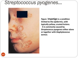 Streptococcus pyogenes…
364
Figure Impetigo is a condition
limited to the epidermis, with
typically yellow, crusted lesions.
It is commonly caused by
Streptococcus pyogenes either alone
or together with Staphylococcus
aureus.
 