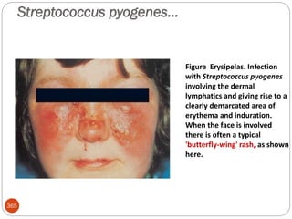 Streptococcus pyogenes…
365
Figure Erysipelas. Infection
with Streptococcus pyogenes
involving the dermal
lymphatics and giving rise to a
clearly demarcated area of
erythema and induration.
When the face is involved
there is often a typical
'butterfly-wing' rash, as shown
here.
 