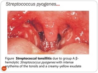 Streptococcus pyogenes…
366
Figure Streptococcal tonsillitis due to group A β-
hemolytic Streptococcus pyogenes with intense
erythema of the tonsils and a creamy-yellow exudate
 