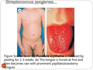 Streptococcus pyogenes…
367
Figure Scarlet fever. (a) Punctate erythema is followed by
peeling for 2-3 weeks. (b) The tongue is furred at first and
then becomes raw with prominent papillae(strawberry
tongue)
 