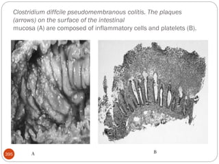 Clostridium diffcile pseudomembranous colitis. The plaques
(arrows) on the surface of the intestinal
mucosa (A) are composed of inflammatory cells and platelets (B).
395 A B
 