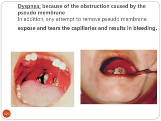 Dyspnea; because of the obstruction caused by the
pseudo membrane
In addition, any attempt to remove pseudo membrane,
expose and tears the capillaries and results in bleeding.
420
 