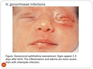 N. gonorrhoeae Infections
431
Figure Gonococcal ophthalmia neonatorum. Signs appear 2-5
days after birth. The inflammation and edema are more severe
than with chlamydia infection.
 