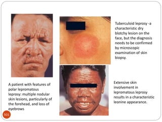 Mycobacterium leprae
501
A patient with features of
polar lepromatous
leprosy: multiple nodular
skin lesions, particularly of
the forehead, and loss of
eyebrows
Tuberculoid leprosy -a
characteristic dry
blotchy lesion on the
face, but the diagnosis
needs to be confirmed
by microscopic
examination of skin
biopsy.
Extensive skin
involvement in
lepromatous leprosy
results in a characteristic
leonine appearance.
 