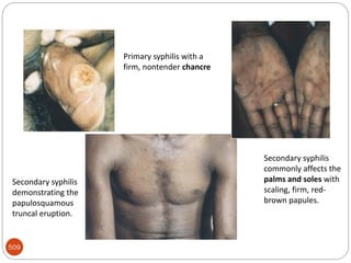 Venereal syphilis
509
Primary syphilis with a
firm, nontender chancre
Secondary syphilis
demonstrating the
papulosquamous
truncal eruption.
Secondary syphilis
commonly affects the
palms and soles with
scaling, firm, red-
brown papules.
 