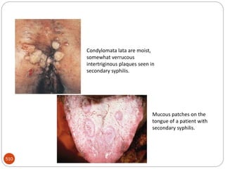Venereal syphilis
510
Mucous patches on the
tongue of a patient with
secondary syphilis.
Condylomata lata are moist,
somewhat verrucous
intertriginous plaques seen in
secondary syphilis.
 