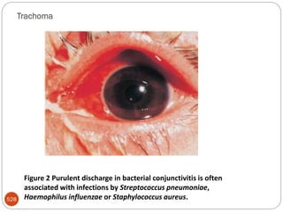 Trachoma
528
Figure 2 Purulent discharge in bacterial conjunctivitis is often
associated with infections by Streptococcus pneumoniae,
Haemophilus influenzae or Staphylococcus aureus.
 