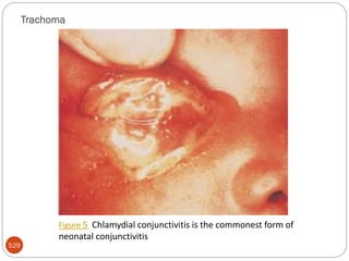 Trachoma
529
Figure 5 Chlamydial conjunctivitis is the commonest form of
neonatal conjunctivitis
 