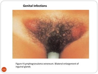 532
Figure 4 Lymphogranuloma venereum. Bilateral enlargement of
inguinal glands
Genital Infections
 