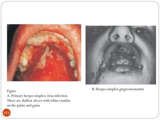 573
Figure
A. Primary herpes simplex virus infection.
There are shallow ulcers with white exudate
on the palate and gums
B. Herpes simplex gingivostomatitis
 