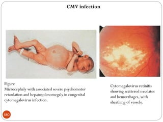 580
Figure
Microcephaly with associated severe psychomotor
retardation and hepatosplenomegaly in congenital
cytomegalovirus infection.
Cytomegalovirus retinitis
showing scattered exudates
and hemorrhages, with
sheathing of vessels.
CMV infection
 
