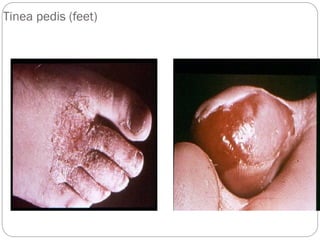 663
Tinea pedis (feet)
 