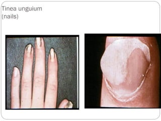 664
Tinea unguium
(nails)
 