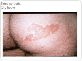 665
Tinea corporis
(the body)
 