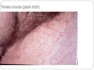 666
Tinea cruris (jock itch)
 