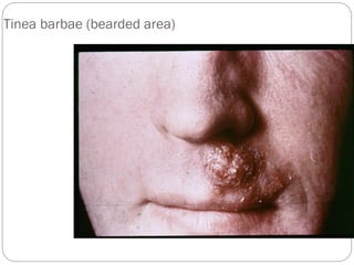 667
Tinea barbae (bearded area)
 